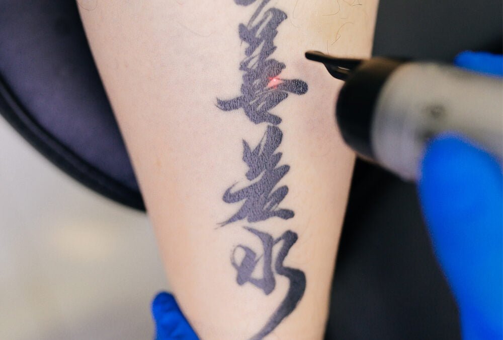 Laser Tattoo Removal