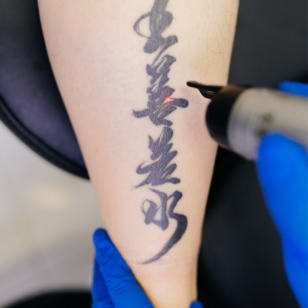 laser tattoo removal laser tattoo removal