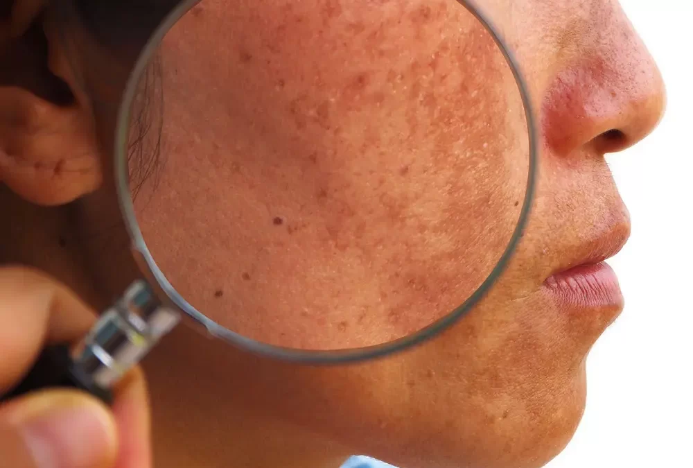 Melasma Laser Treatment